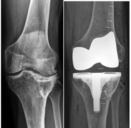 foscal_implanto_la_primera_protesis_anatomica_de_rodilla_0