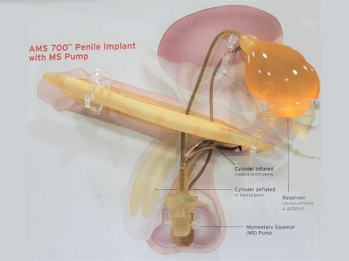 Manejo prótesis de pene inflable