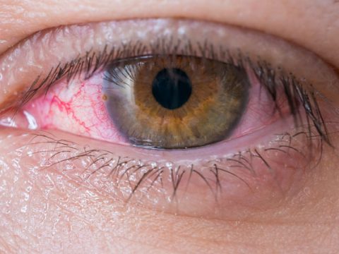 Cuidado con la Conjuntivitis viral