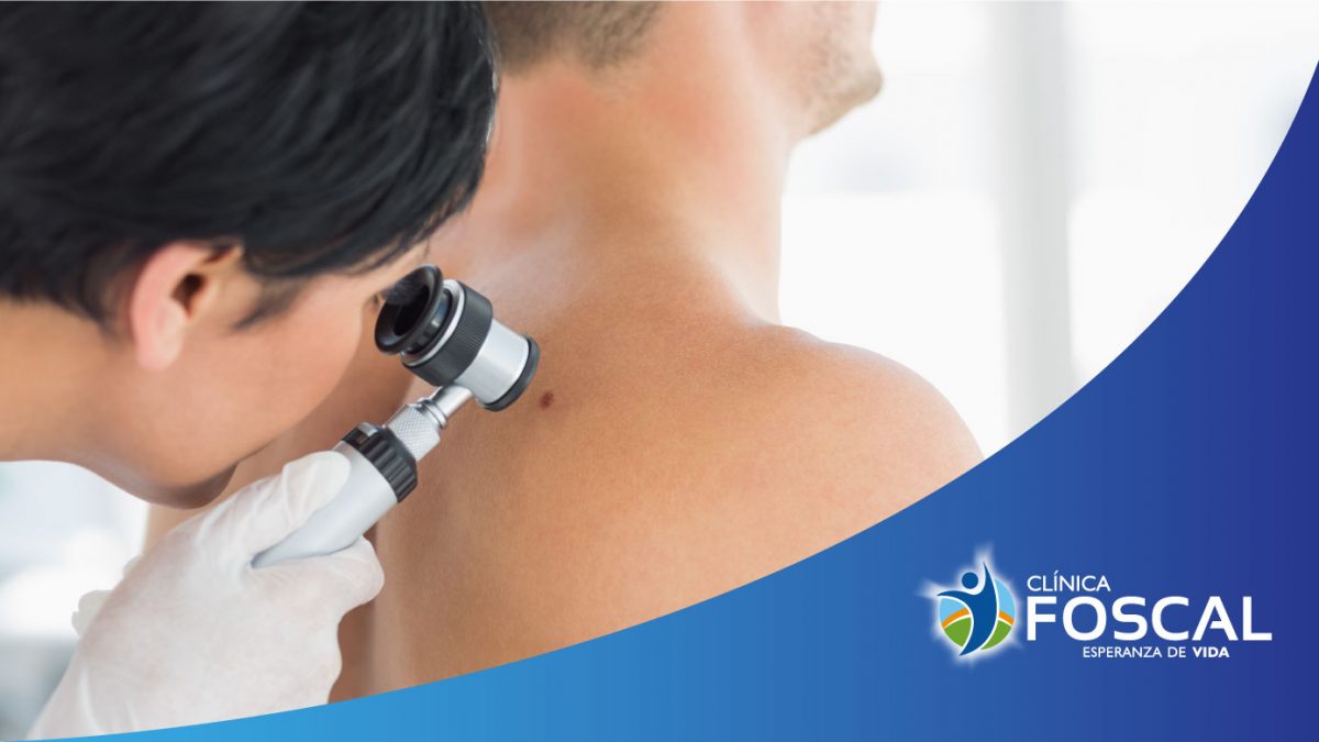 Preguntas y respuestas sobre el cáncer de piel