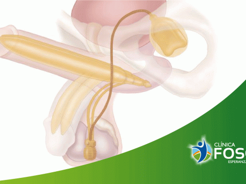 Prótesis hidráulica en el pene: Un procedimiento quirúrgico que te regresará la calidad de vida